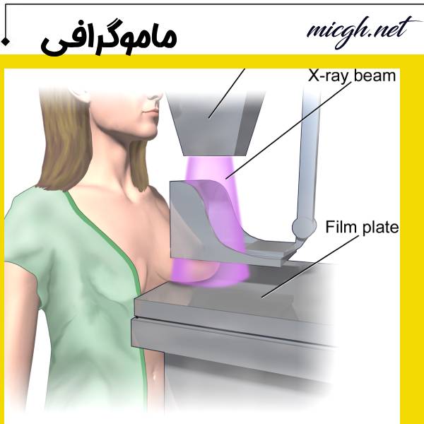 ماموگرافی