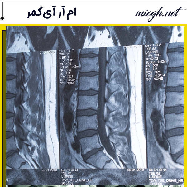 عکس ام آر ای کمر