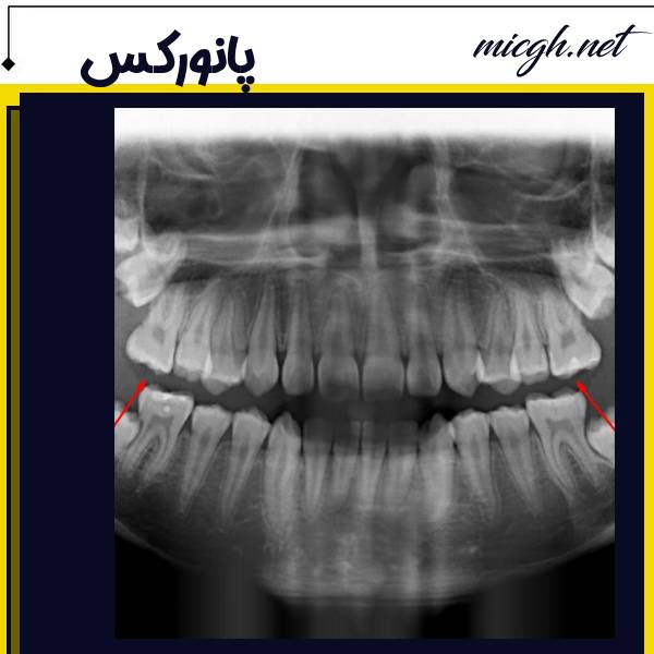 پانورکس