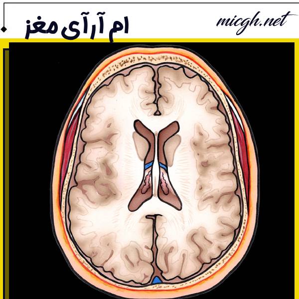 عکس ام آر آی مغز